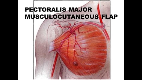 pectoralis major lappen|Does Pectoralis Major Myocutaneous Flap Cause the Shoulder。